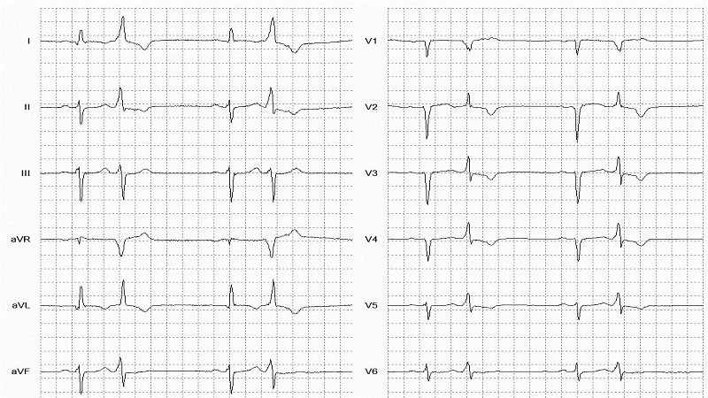 Ventricular Bigeminy 12 Lead EKG